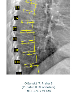 osteoporóza 