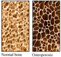 osteoporóza